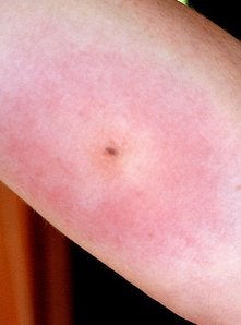 Brazilian Wandering Spider Bite